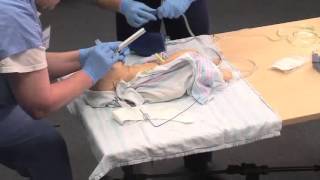 Using a Meconium Aspirator [upl. by Acimaj]