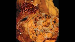 Blasted Pancreas  Carcinoma Full Album [upl. by Tamaru]