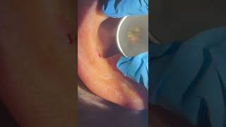 For all my forcep fanboys earwax satisfying ears extractions earcleaning extraction [upl. by Rumit]