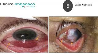 NEOPLASIA ESCAMOSA DE LA SUPERFICIE OCULAR [upl. by Tadd]