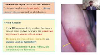 Type III – Hypersensitivity Reactions Part 3 [upl. by Aelyk]