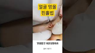 얼굴 멍울 수술 핀홀법 피지낭종 표피낭종 피부과 성형외과 병원 epidermal epidermoid cyst surgery seoul korea아문TV [upl. by Florie82]