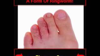 Ringworm Pics  How To Know If You Are Infected [upl. by Olive]