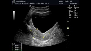 ECOGRAFÍA ABDOMINO PÉLVICA  ECOGRAFÍA DE ÚTERO Y ANEXOS  ULTRASONIDO ABDOMINAL ECOGRAFÍA OVARIOS [upl. by Nniuq396]