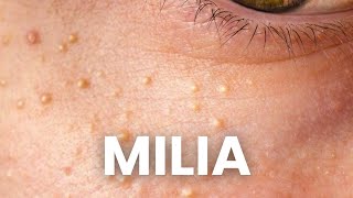 3 Proven Strategies to Remove Milia that WORK [upl. by Nekal]