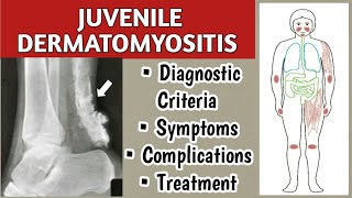 Juvenile Dermatomyositis Symptoms Diagnostic Criteria Complications and Treatment [upl. by Aitnic21]