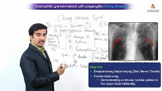 Eosinophilic granulomatosis with polyangiitis  ChurgStrauss Syndrome [upl. by Anomis]