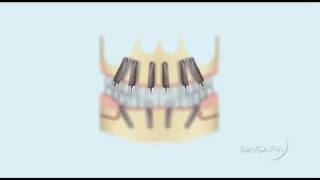 WINSIX Extreme Abutment ® Teeth Just On 6 [upl. by Haleak]