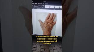 actinic keratosis should be destroyed either chemically or surgically actinickeratosis [upl. by Gilmore]