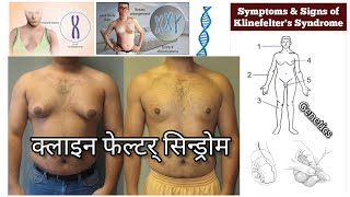 Klinefelter Syndrome  क्लाइनफेल्टर सिन्ड्रोम क्या है Klinefelter Syndrome causes symptoms in hindi [upl. by Nayar715]