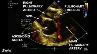 NonOcclusive Pulmonary Embolus on TEE [upl. by Gnehp484]