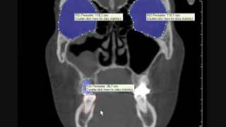 3D volume rendering DVT of female skull with maxillary sinusitis and dental cyst [upl. by Roxie]