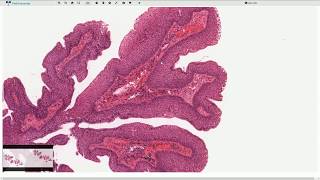 Squamous Papilloma  Larynx  Histopathology [upl. by Jc]