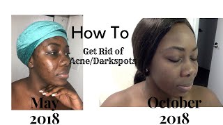 How to get rid of acne amp dark spots  using Aveeno Products [upl. by Casteel]