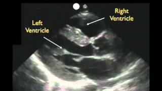 Cardiac Ultrasound  Parasternal Long Axis  Part 1  Sonosite Inc [upl. by Roehm532]