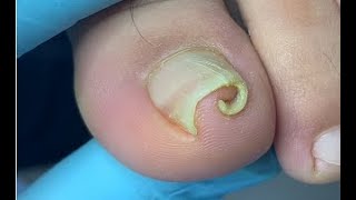 How to repair curled nail [upl. by Avenej494]