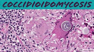 Coccidioidomycosis Coccidioides 5Minute Pathology Pearls [upl. by Latif]