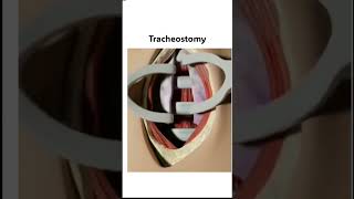 Tracheostomy shorts mbbs femalereproductivesystem pregnancy [upl. by Akiaki]