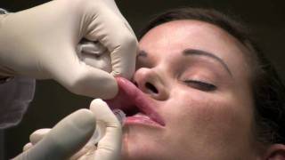 Dental Block Lip Numbing for Lip Augmentation by Northern Virginia Cosmetic Surgeon [upl. by Dragelin]