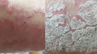 EXTREME REGENERATION 1 WEEK AFTER FULL CLEANING Psoriasis [upl. by Ayotnom]