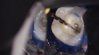 Endodontic in Ramadan  الحلقة الأولي  Diagnosis  part 1 [upl. by Nohsav]