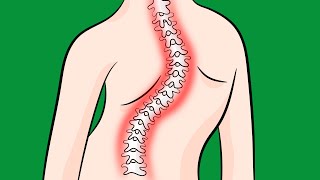 How to Fix Idiopathic Scoliosis Naturally [upl. by Velvet848]