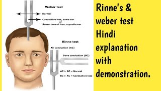 Rinne amp Weber test demonstration in Hindi explanation msn gnmcourse nursing ear [upl. by Irene127]