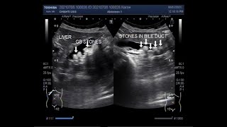 Cholelithiasis associated with Choledocholithiasis [upl. by Levitan]