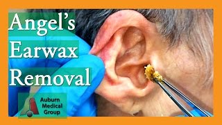 Angels Earwax Removal  Auburn Medical Group [upl. by Eidlog353]