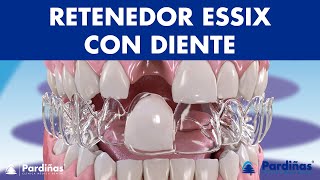 Retenedor ESSIX con diente  Una solución provisional para los DIENTES FALTANTES © [upl. by Atileda]