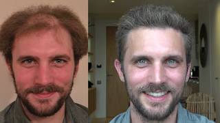 6109 Graft FUT Hair Transplant Hattingen Hair  4 Year before and after [upl. by Enautna443]