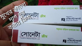 ব্রণে soneta cream সরাসরি ব্যবহার করা যাবে কিনা  mukher kalo dag dur korar cream [upl. by Sethi972]