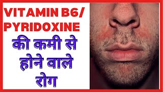 Vitamin B6 pyridoxine ki kami se hone wale rog  Deficiency symptom diseases Food source in hindi [upl. by Leckie]