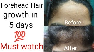 Forehead hair growth in just 5 🤩Amazing result in 5days 💯Haircare by priyavaisu [upl. by Meras]