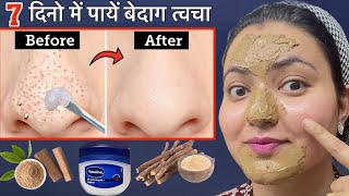 कितने भी जिद्दी Blackhead Whitehead कील सफेद दानेClogged Pores Scars हों इस Remedy से होगा कमाल💕 [upl. by Iveson68]