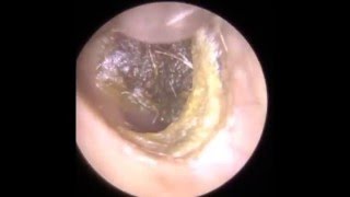 Endoscopic Ear Wax Removal Leicester  The Hear Clinic [upl. by Netsyrc232]