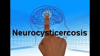 Neurocysticercosis NCC Types Clinical manifestations Diagnosis and Management [upl. by Ahsemaj570]