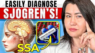 How to Diagnose Sjogrens Disease [upl. by Hendrix]