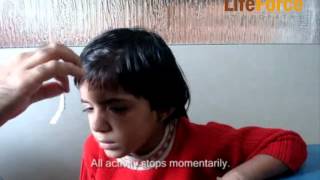 Video of Child with Petit Mal Epilepsy Attack Induced by Exertion Physical Effort [upl. by Llohcin131]