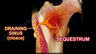 Pathology 825 f Pyogenic Osteomyelitis Pathogenesis Gross Involucrum Brodies abscess [upl. by Lurleen]