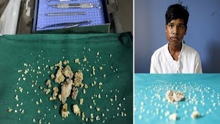 Indian Teen Ashik Gavai Has 232 Teeth Removed In 7 Hours Operation [upl. by Falk]