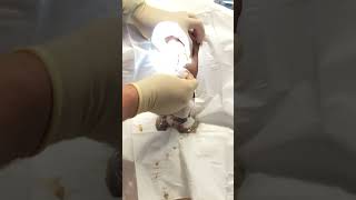 Exploding grapefruit sized sebaceous cyst popping [upl. by Thesda59]