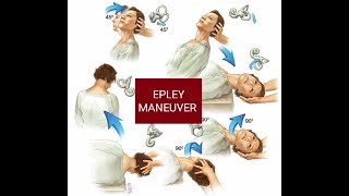 EPLEY MANEUVER  Canalith Repositioning Procedure CRP  Treatment of BPPVHow to do Epley maneuver [upl. by Omarr]