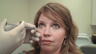 Juvéderm™ Tear Trough Treatment Huntsville Alabama  Dr David L Durst [upl. by Neelat]