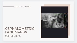 CEPHALOMETRIC LANDMARKS [upl. by Adnilab]