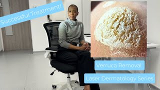 Verruca Wart Removal Laser Treatment [upl. by Estele711]