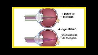 Symptome von Astigmatismus und wie man behandelt [upl. by Haveman]