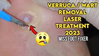 LASER TREATMENT OF A PAINFUL FOOT WART  VERRUCA 2023 BY FAMOUS FEETT SPECIALIST MISS FOOT FIXER [upl. by Ytak]