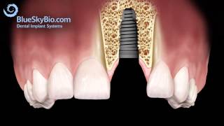 Patient Treatment Videos Implants [upl. by Amehr175]