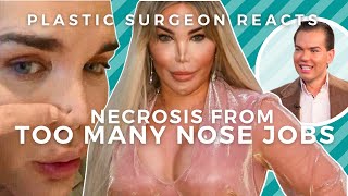 Nose Job Necrosis How Jessica Alves Skin Died From Botched Rhinoplasties [upl. by Etnauq579]